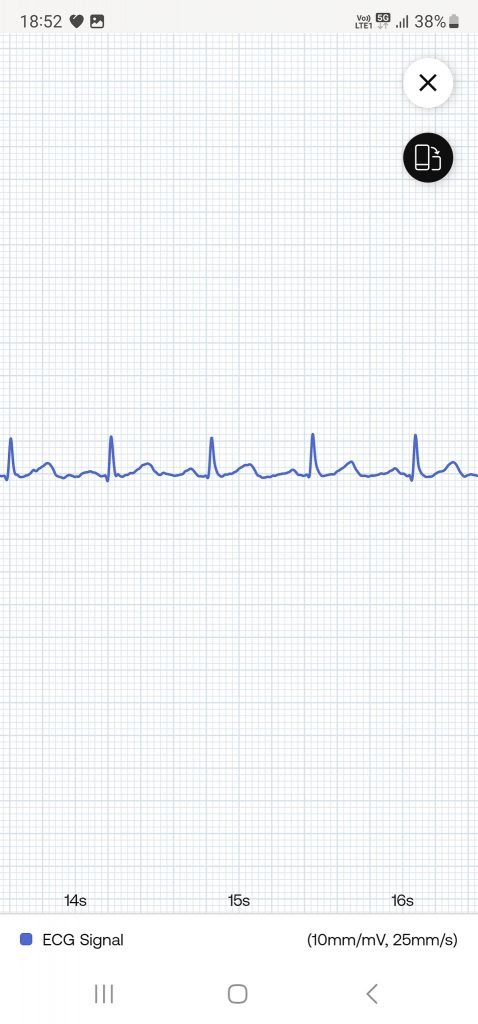 Withings ScanWatch 2 Smartwatch App EKG